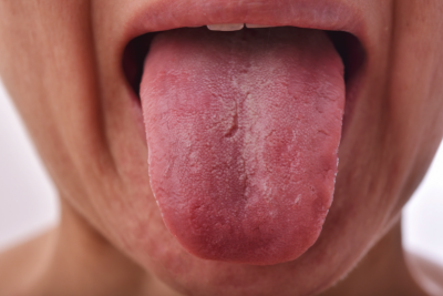 What Your Tongue Says About Your Health, according to the Traditional Chinese Medicine