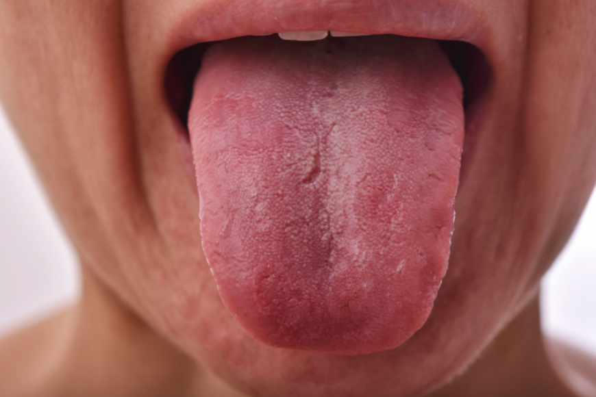 What Your Tongue Says About Your Health, according to the Traditional Chinese Medicine